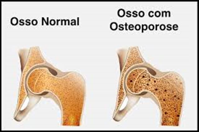 osteoporose Magnum Plus